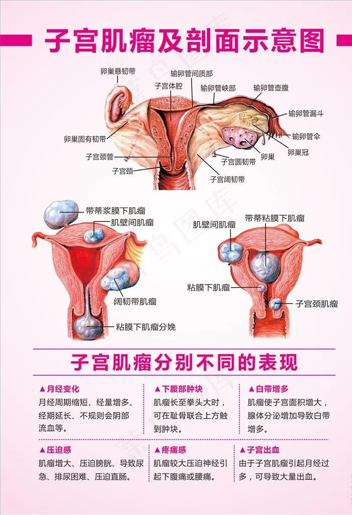 子宫肌瘤示意图 子宫肌瘤表现图片