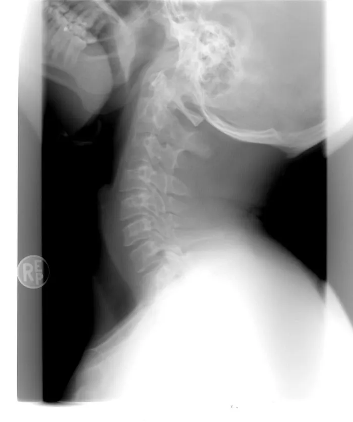 脊椎x射线，x射线，颈椎，医疗保健，损伤，x射线图像，骨骼，医用x射线