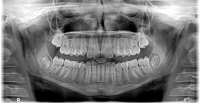 x射线照片，人类，头骨，x射线，x射线，照片，伦琴，牙齿