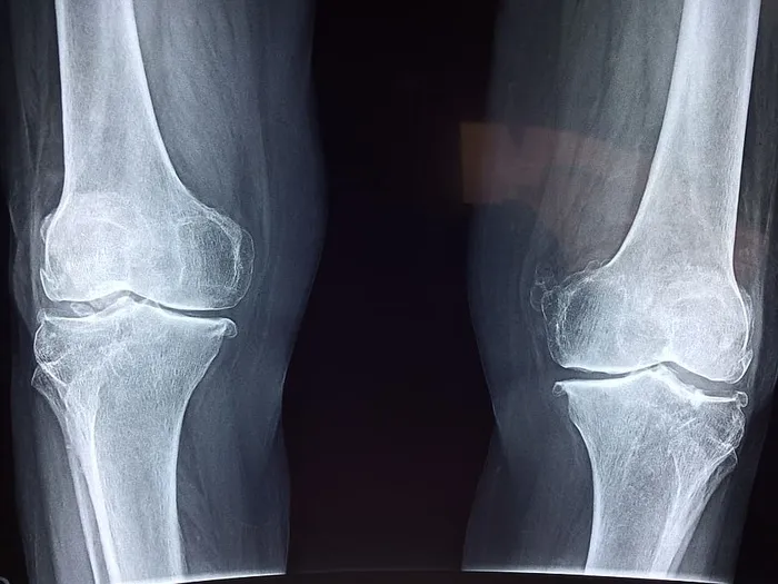照片，人类，腿膝盖x射线结果，膝盖，x射线，医学，解剖学，骨骼