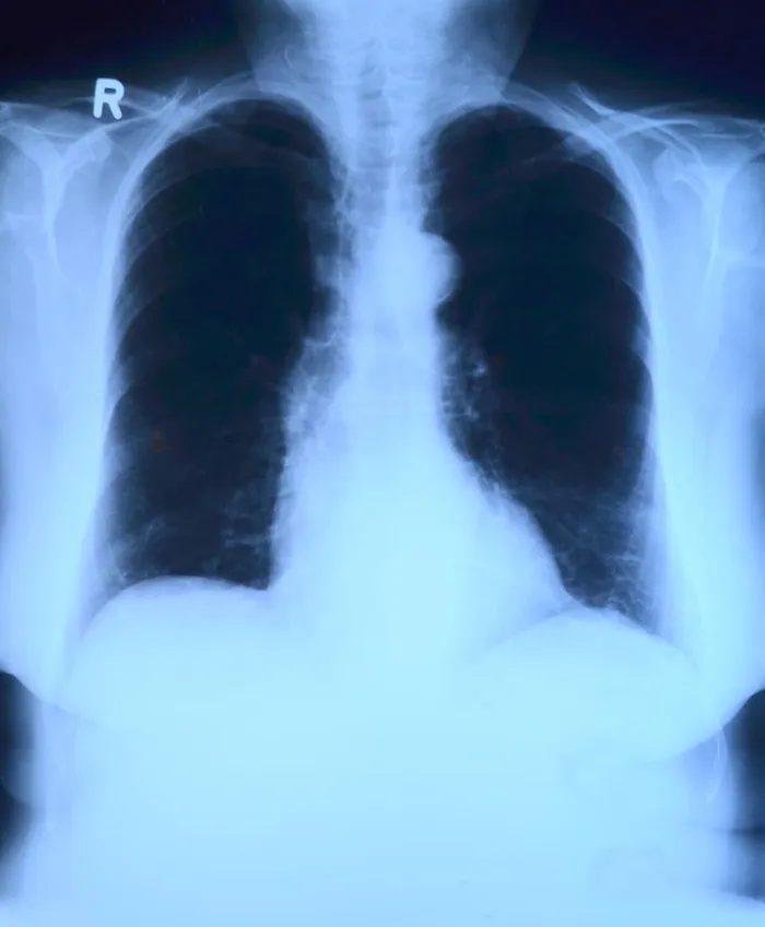 x射线照片，x射线图像，x射线，胸部，肺部x射线，医学，医学检查，医疗保健和医学