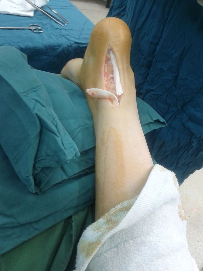 跟腱,肌腱,断裂,医学,解剖学,损伤,手术,腿